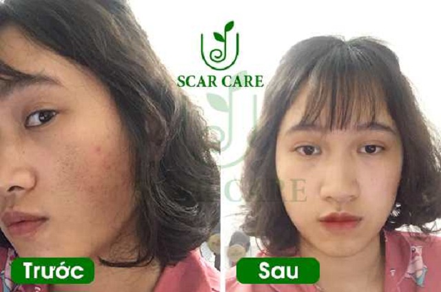 THUỐC TRỊ SẸO SCAR CARE (2)